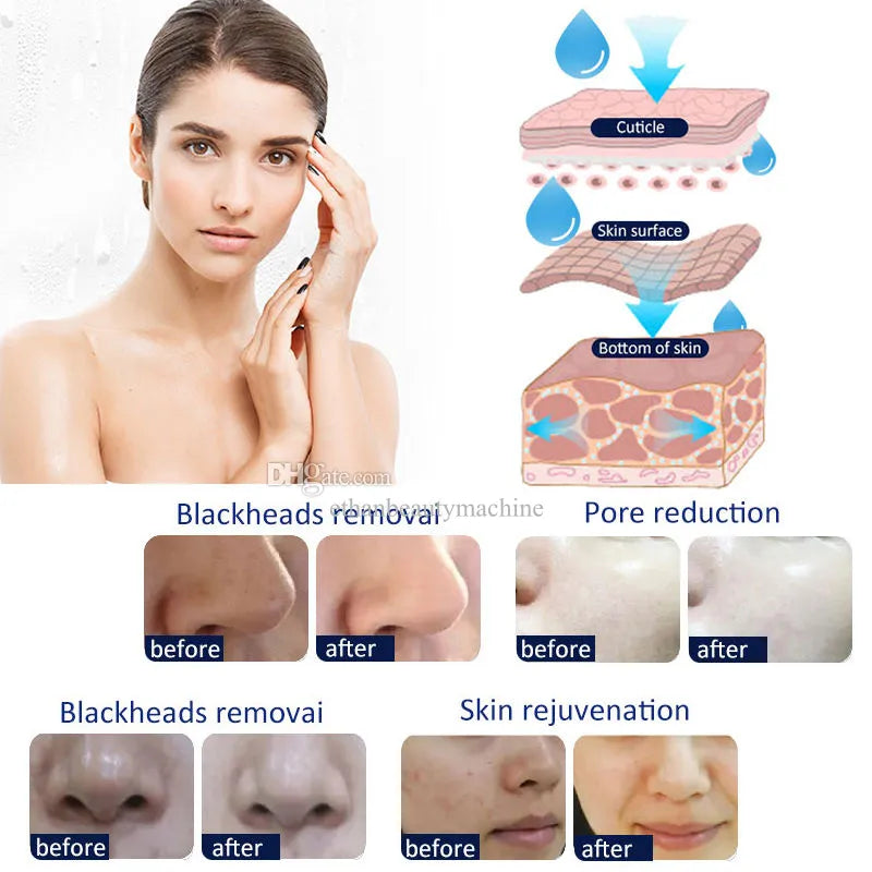 Appareil de Microdermabrasion – Embout Diamant