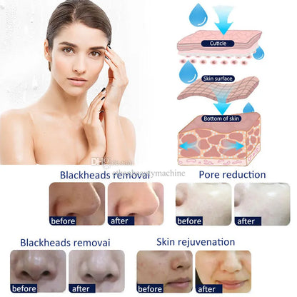 Appareil de Microdermabrasion – Embout Diamant